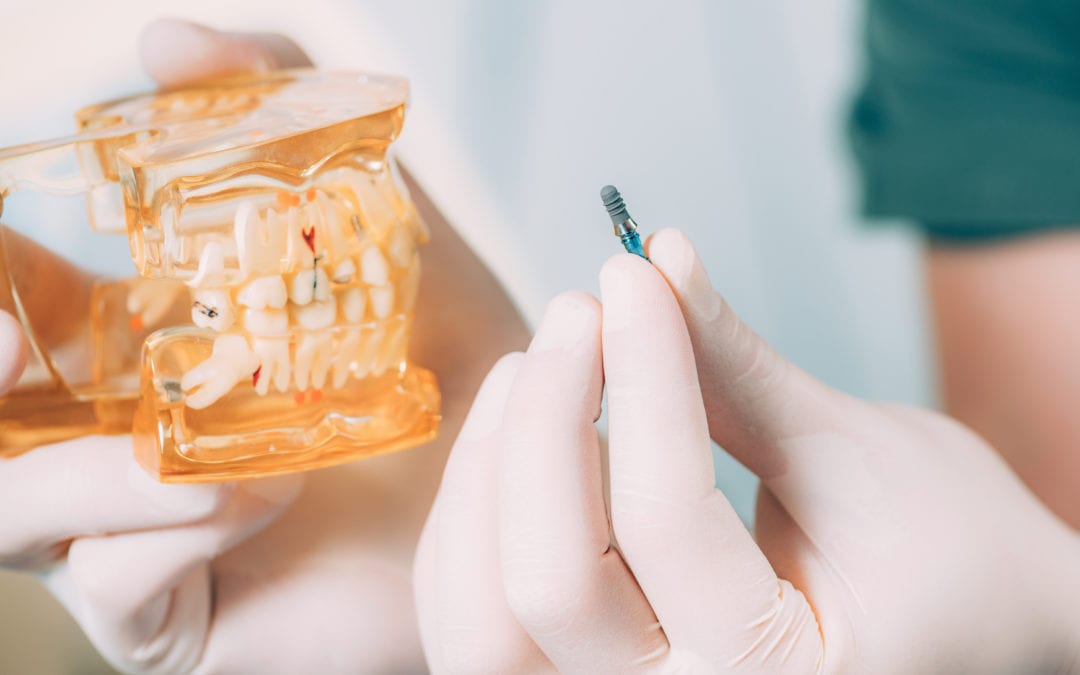 A Quick Guide To Dental Implants