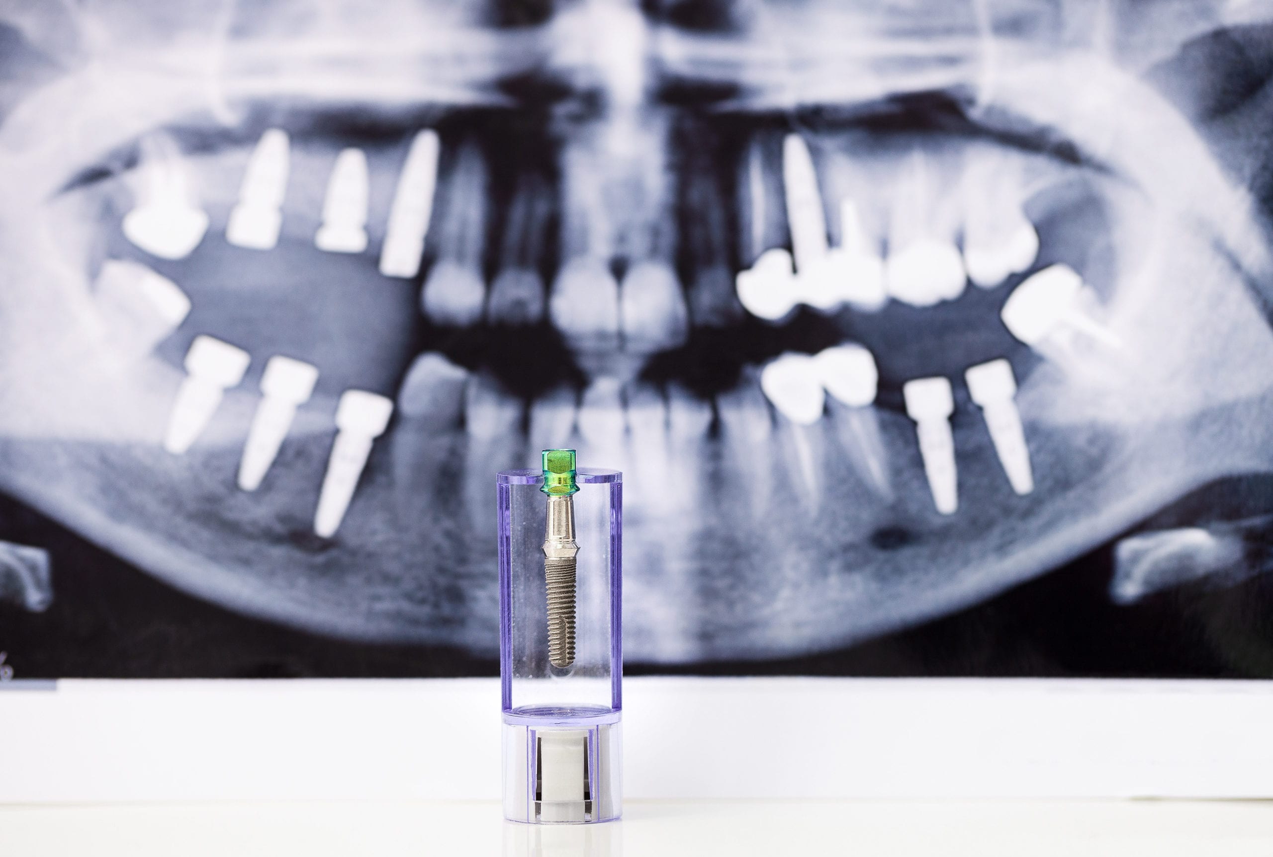 cost of dental implants in Houston