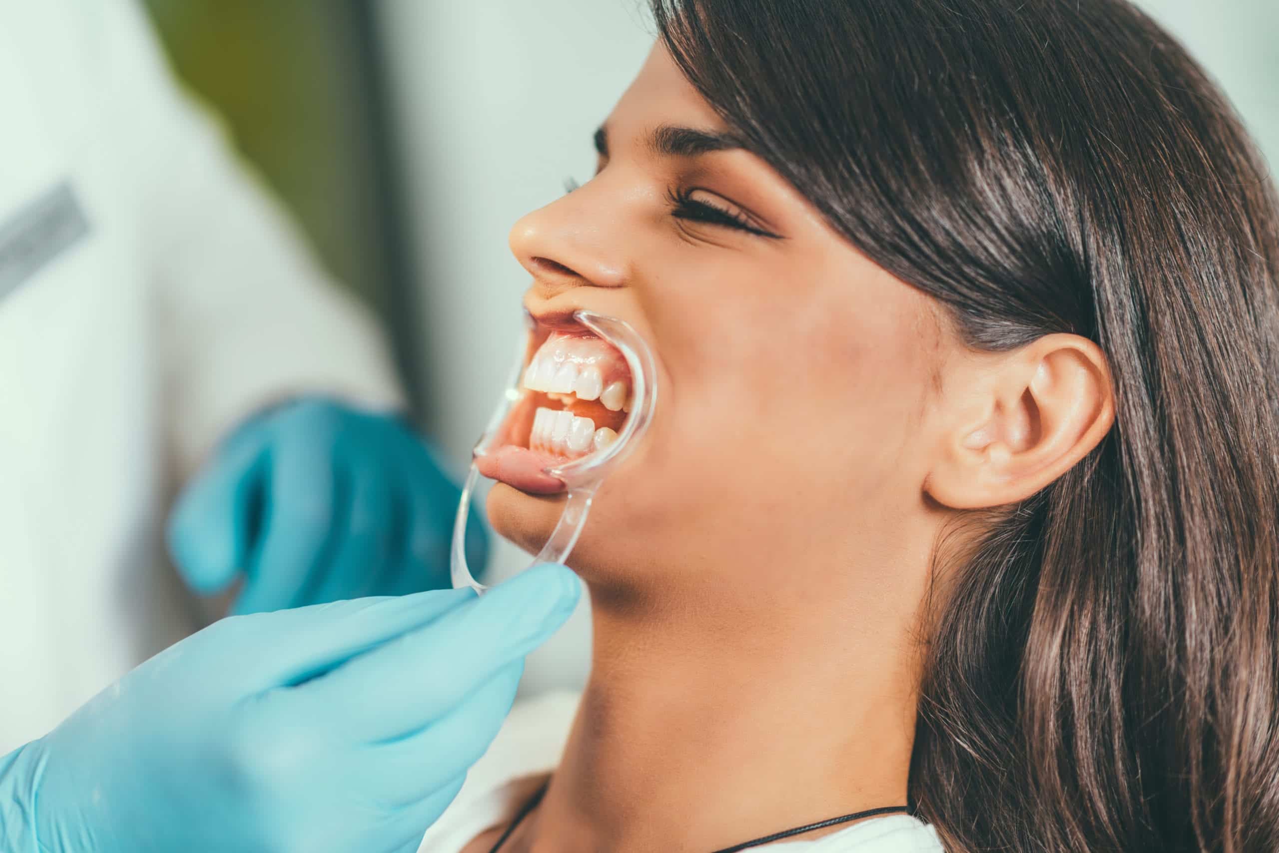 Tooth whitening procedure cosmetic dentistry in Houston