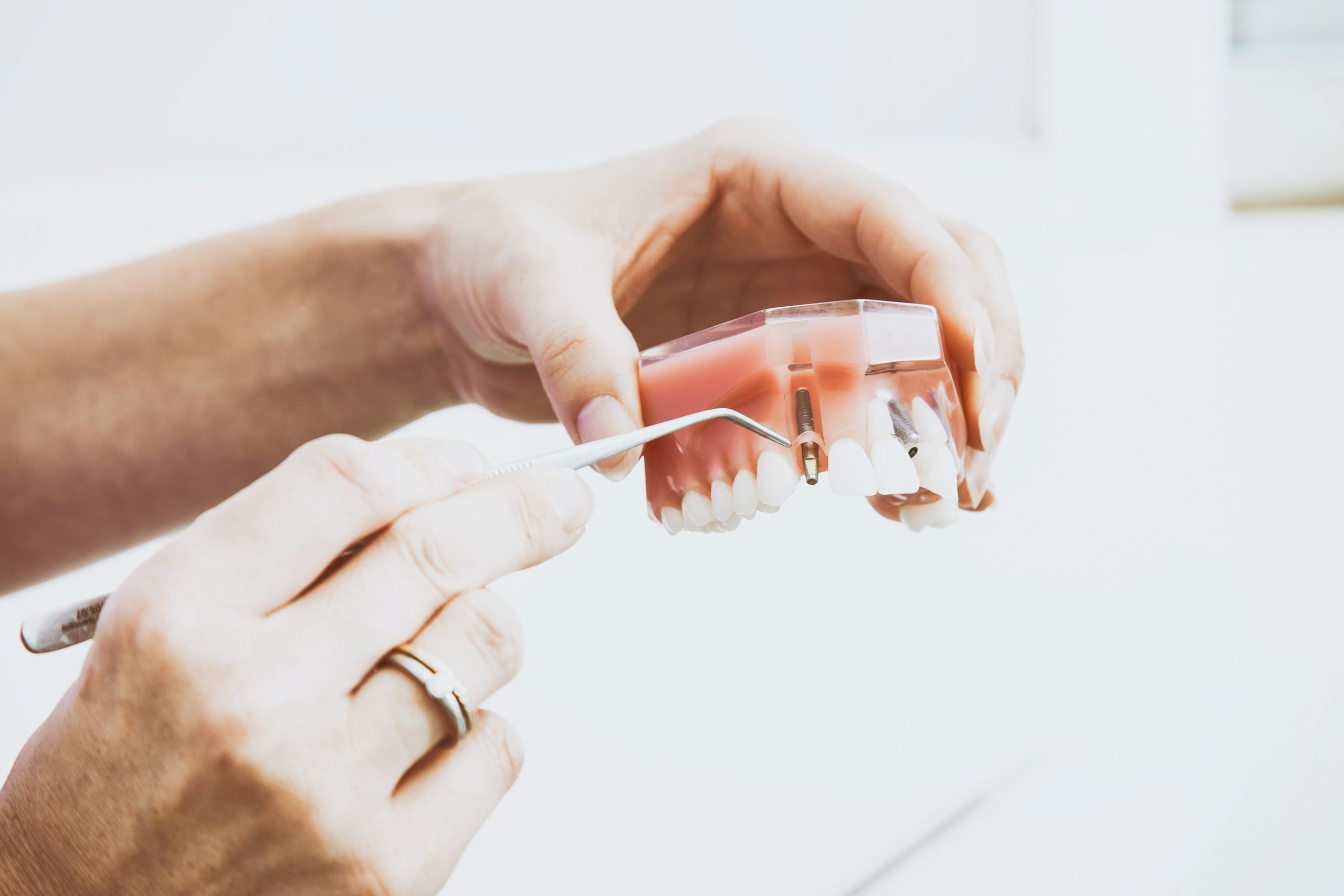 Time to consider dental implants?